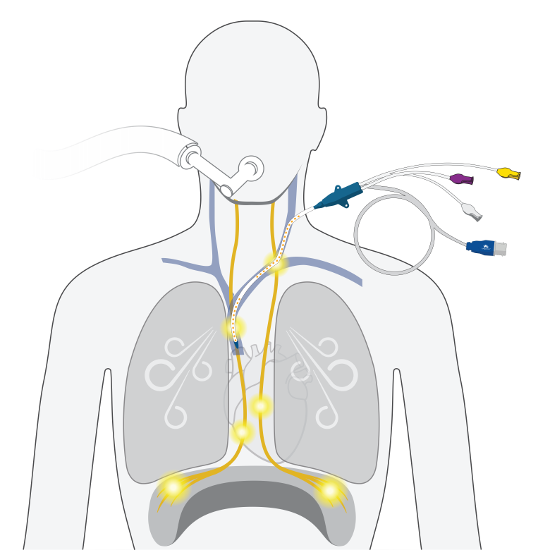 An illustration of the LungPacer AeroPace® System, which is delivered through a central venous catheter and directly stimulates the nerve responsible for activating the diaphragm.